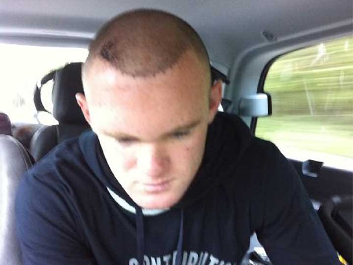 Rooney mostra o seu transplante de cabelo